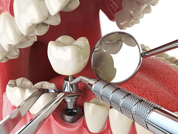 Teeth Whitening in SC